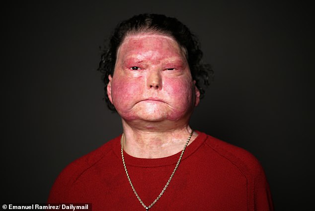 Drowsy Driving Crash Leaves Joseph DiMeo with Severe Burns and Coma