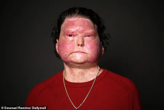 Drowsy Driving Crash Leaves Joseph DiMeo with Severe Burns and Coma