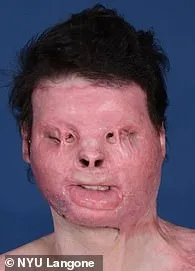 Drowsy Driving Crash Leaves Joseph DiMeo with Severe Burns and Coma