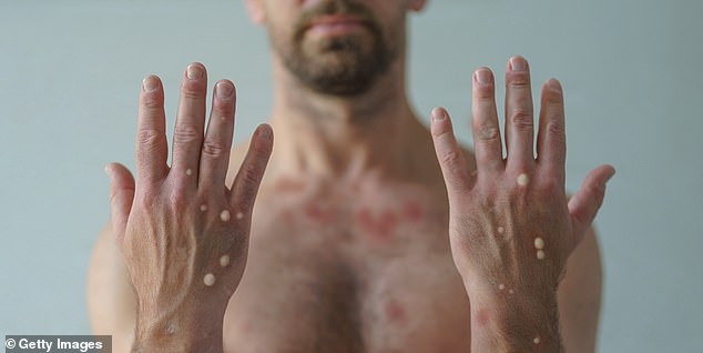 New York City Reports First Local Case of Clade I Mpox Since November 2024