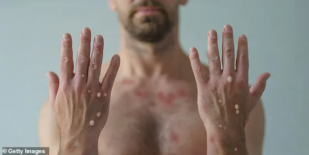 New York City Reports First Local Case of Clade I Mpox Since November 2024