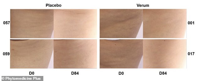 Pycnogenol: A Natural Oral Solution for Cellulite Shows Promising Results in 90-Day Clinical Study