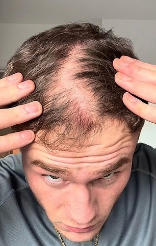 Social Media Creator's Hair Loss Crisis: Confidence Shattered, Hair Fibers Become Lifeline