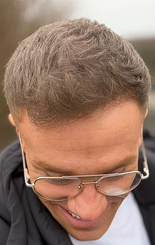 Social Media Creator's Hair Loss Crisis: Confidence Shattered, Hair Fibers Become Lifeline