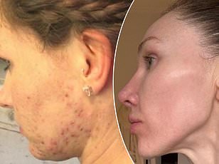 Collagen Supplements Show Promise for Skin and Joints, But Expert Warns Against Overhyping Benefits