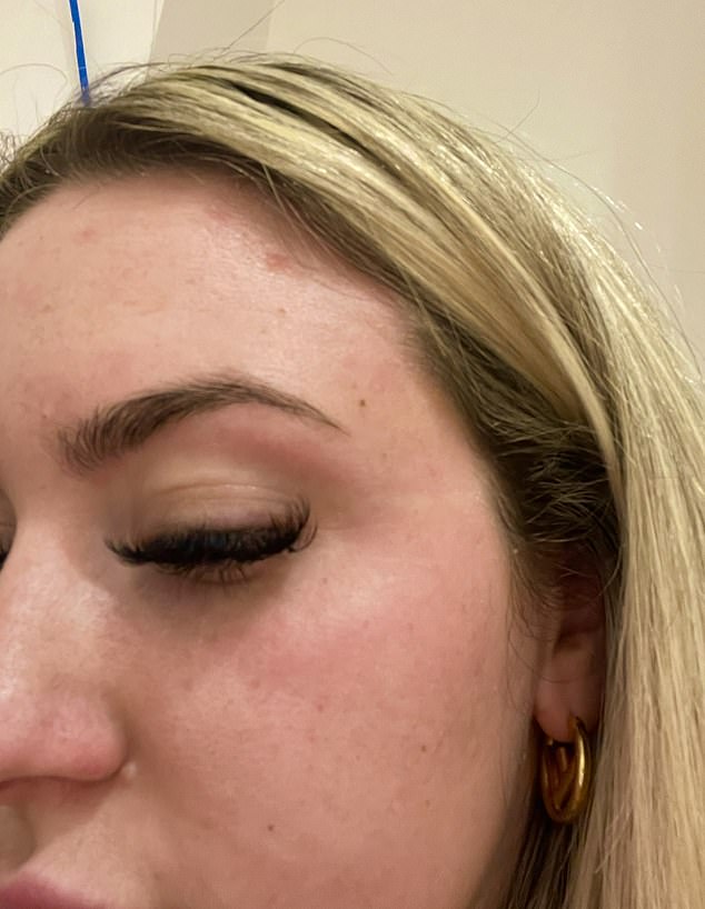 Shannon Higham's 14-Year Battle with Psoriasis: From Schoolyard Bullying to a Lifelong Struggle