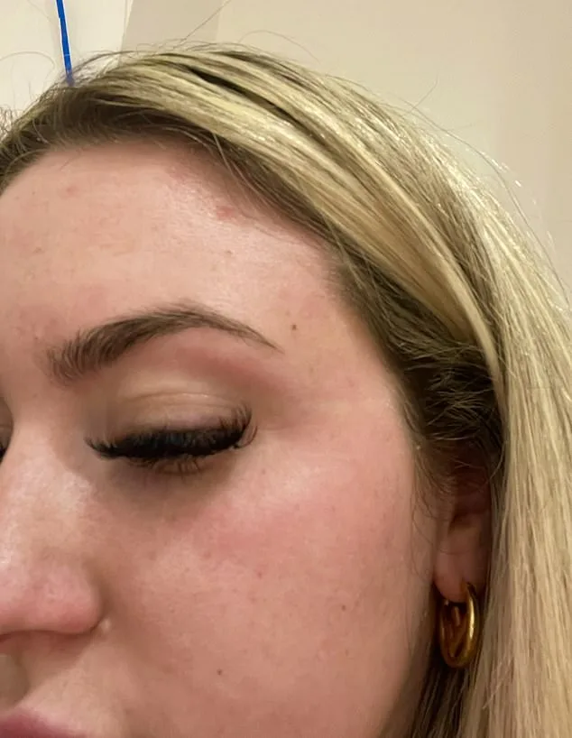 Shannon Higham's 14-Year Battle with Psoriasis: From Schoolyard Bullying to a Lifelong Struggle