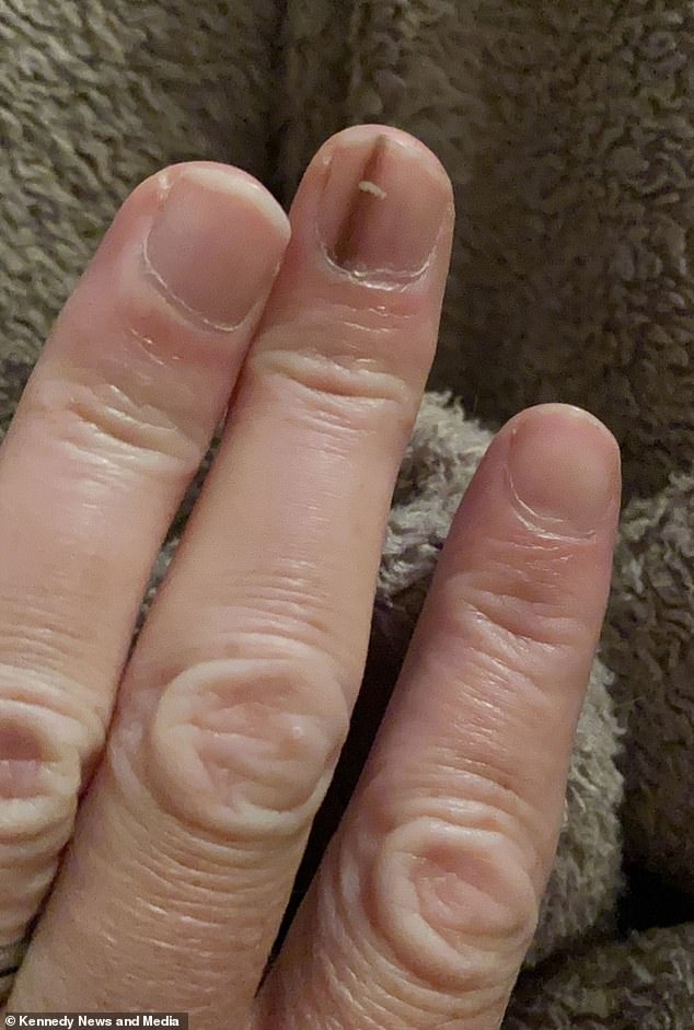A Faint Brown Line Under the Nail: The Hidden Danger of Subungual Melanoma