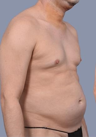 From Stubborn Fat to Sculpted Abs: Why More Men Are Choosing Liposuction Over Diet and Exercise