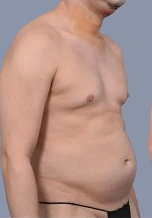 From Stubborn Fat to Sculpted Abs: Why More Men Are Choosing Liposuction Over Diet and Exercise