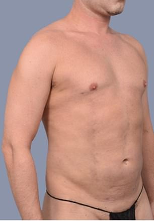 From Stubborn Fat to Sculpted Abs: Why More Men Are Choosing Liposuction Over Diet and Exercise