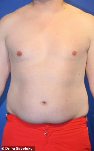 From Stubborn Fat to Sculpted Abs: Why More Men Are Choosing Liposuction Over Diet and Exercise