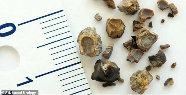 Kidney Stones Surge Among Younger Americans: A Growing Health Crisis