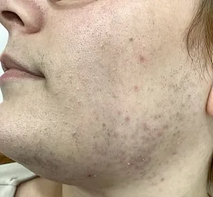 Breakthrough Treatment Offers Hope for Women Battling Unwanted Facial Hair Linked to Hormonal Imbalances