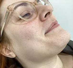 Breakthrough Treatment Offers Hope for Women Battling Unwanted Facial Hair Linked to Hormonal Imbalances