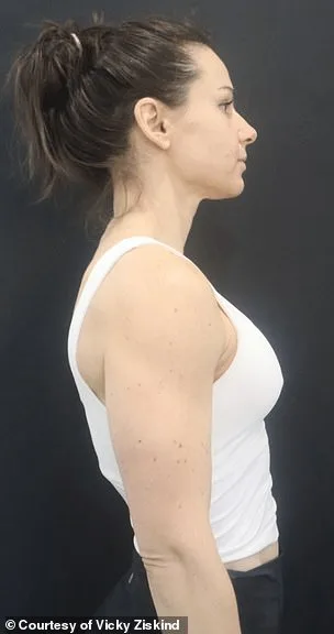 Revolutionary Minimally Invasive Technique Redefines Breast Augmentation