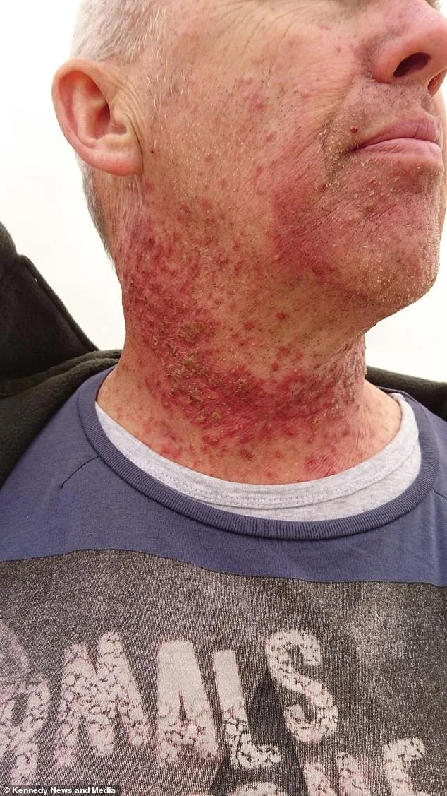 Oropharyngeal Cancer: Scotland Man's Shocking Diagnosis.