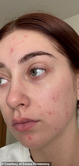 Celebrities praise microdose isotretinoin for youthful skin despite hidden dangers.