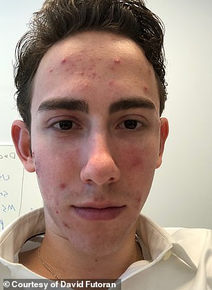 Celebrities praise microdose isotretinoin for youthful skin despite hidden dangers.