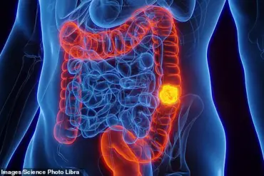 Blood Test Detects Early Signs of Bowel Cancer, Offering Hope for Improved Survival Rates