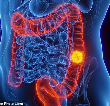 Blood Test Detects Early Signs of Bowel Cancer, Offering Hope for Improved Survival Rates