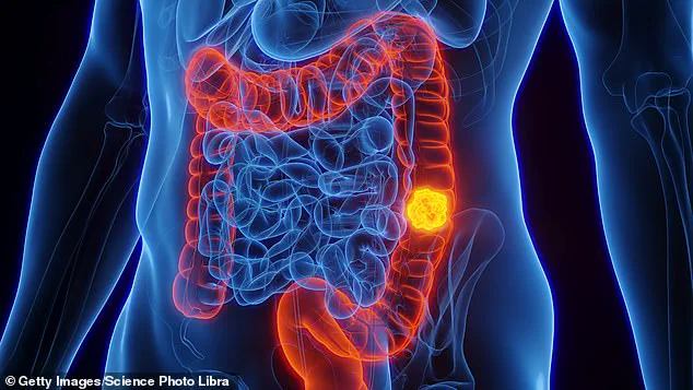 Blood Test Detects Early Signs of Bowel Cancer, Offering Hope for Improved Survival Rates