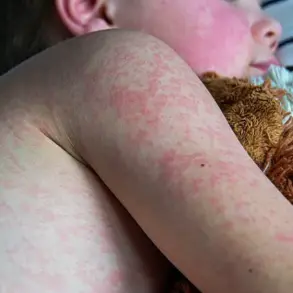 Measles Cases Surpass 2024 Annual Total in Just Three Months, CDC Reports Crisis