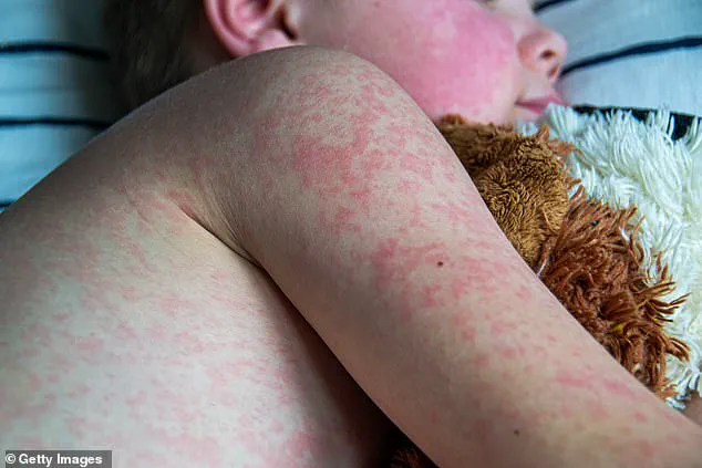 Measles Cases Surpass 2024 Annual Total in Just Three Months, CDC Reports Crisis