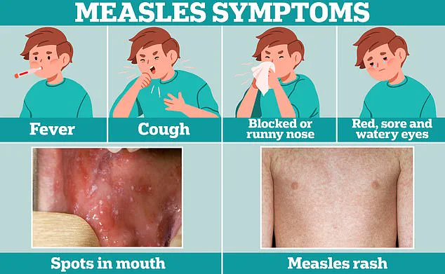 Measles Outbreak at LAX: Terminal B Identified as Potential Exposure Site