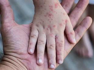 Measles Outbreak in the US: A Growing Concern