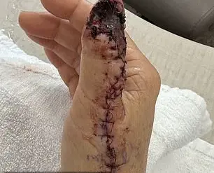 Ohio Mother's Thumb Turned Out to Be a Life-Saving Discovery