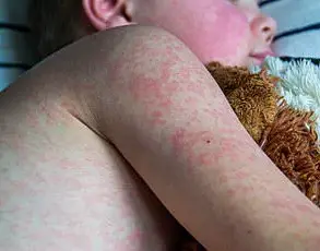 Ontario Teacher Marcy Warns About Measles Breakthrough Infection Despite Vaccination