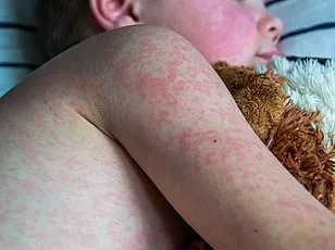 Ontario Teacher Marcy Warns About Measles Breakthrough Infection Despite Vaccination