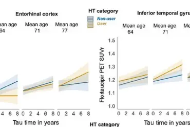 Study Reveals Higher Alzheimer's Risk for Older Women Using Hormone Replacement Therapy