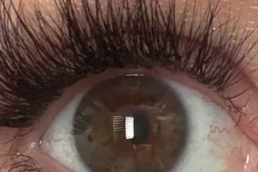Woman Struck by Lightning Awakens with Different Eye Color