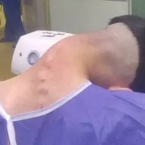 Exclusive: Shocking Images Reveal Dropped Head Syndrome in a 23-Year-Old Drug User, Published by Alzahra Hospital in Iran