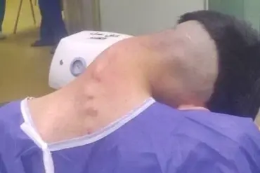 Exclusive: Shocking Images Reveal Dropped Head Syndrome in a 23-Year-Old Drug User, Published by Alzahra Hospital in Iran