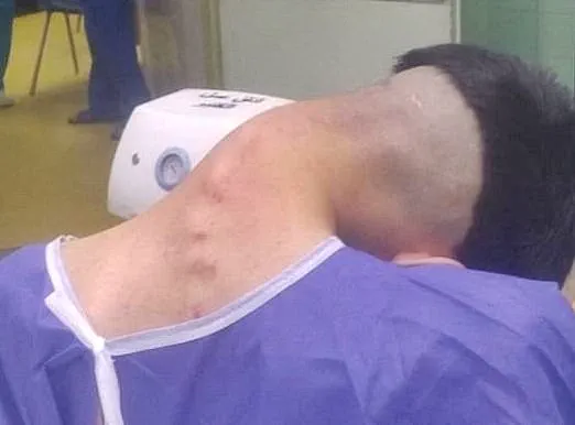 Exclusive: Shocking Images Reveal Dropped Head Syndrome in a 23-Year-Old Drug User, Published by Alzahra Hospital in Iran