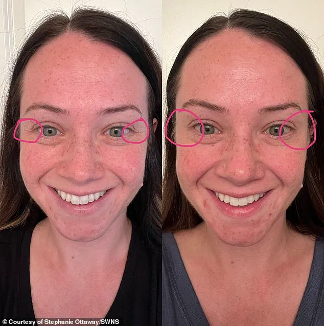 From Cosmetic Procedure to Life-Threatening Illness: The Hidden Risks of Xeomin Injections