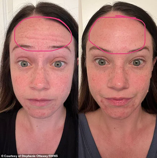 From Cosmetic Procedure to Life-Threatening Illness: The Hidden Risks of Xeomin Injections