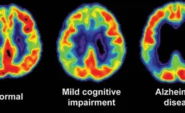 Late-Breaking: Woman's Rare Diagnosis Linked to Sudden Memory Lapses and Daily Struggles