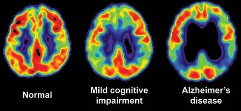 Late-Breaking: Woman's Rare Diagnosis Linked to Sudden Memory Lapses and Daily Struggles