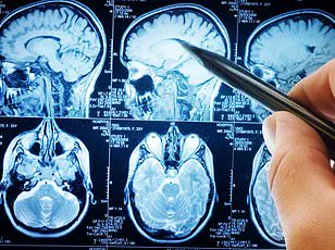 Midlife Depression Linked to 56% Higher Dementia Risk: A Wake-Up Call for Global Mental Health Strategies