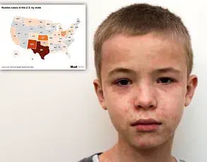 North Dakota Enforces Mandatory Quarantine for 200 Students Amid Measles Exposure, Underlining Public Health Precautions