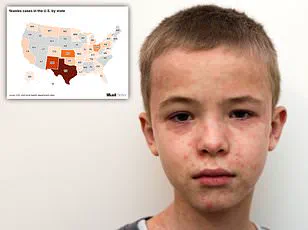 North Dakota Enforces Mandatory Quarantine for 200 Students Amid Measles Exposure, Underlining Public Health Precautions