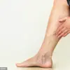 South Korean Study Reveals Varicose Veins Linked to Increased Dementia Risk in Large-Scale Analysis