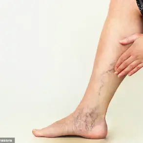 South Korean Study Reveals Varicose Veins Linked to Increased Dementia Risk in Large-Scale Analysis