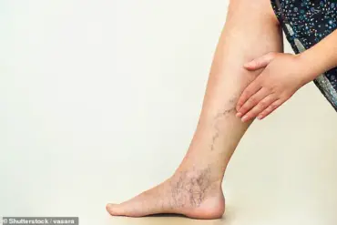 South Korean Study Reveals Varicose Veins Linked to Increased Dementia Risk in Large-Scale Analysis
