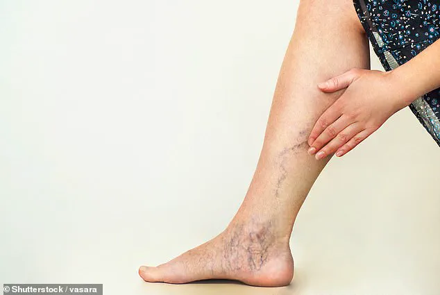 South Korean Study Reveals Varicose Veins Linked to Increased Dementia Risk in Large-Scale Analysis