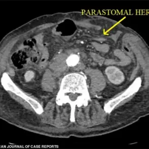 83-Year-Old Man Faces Life-Threatening Spontaneous Evisceration After Routine Hernia Repair
